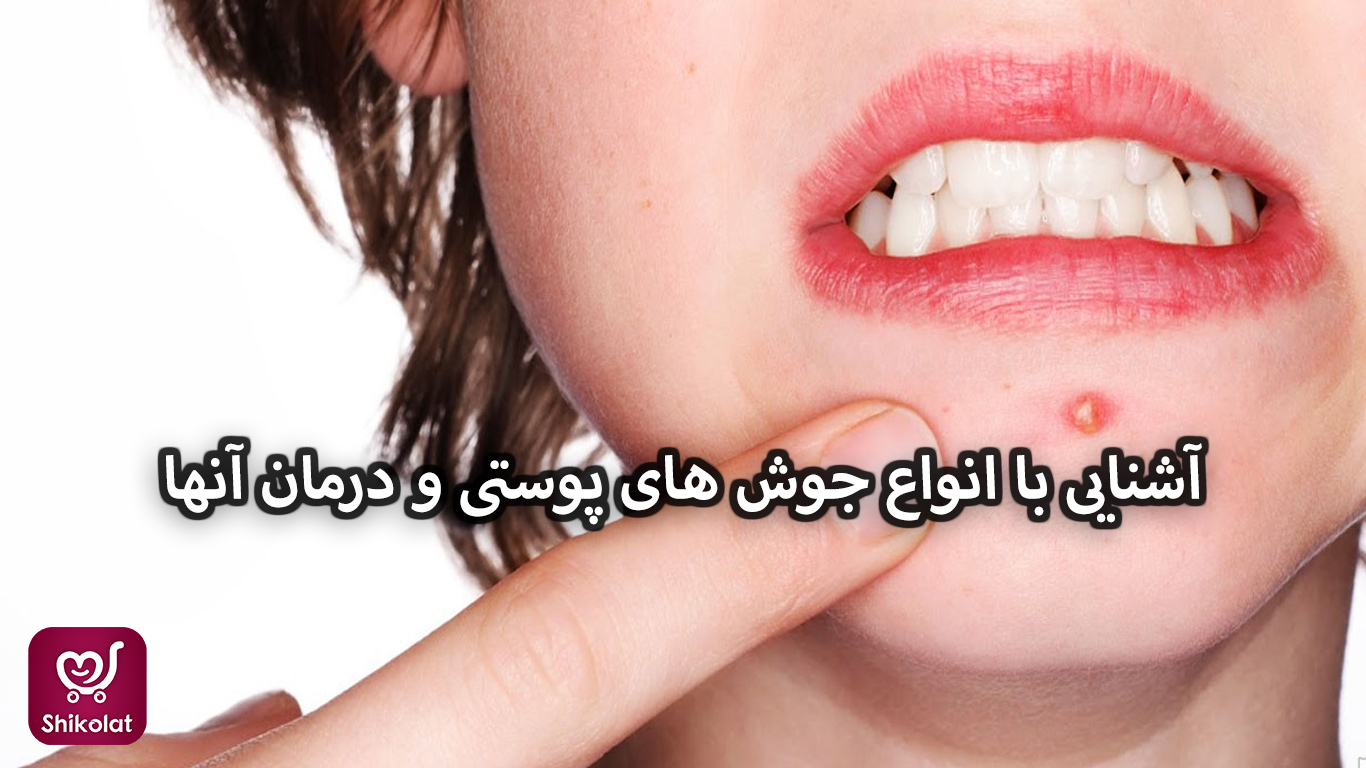 آشنایی با انواع جوش های پوستی و درمان آنها