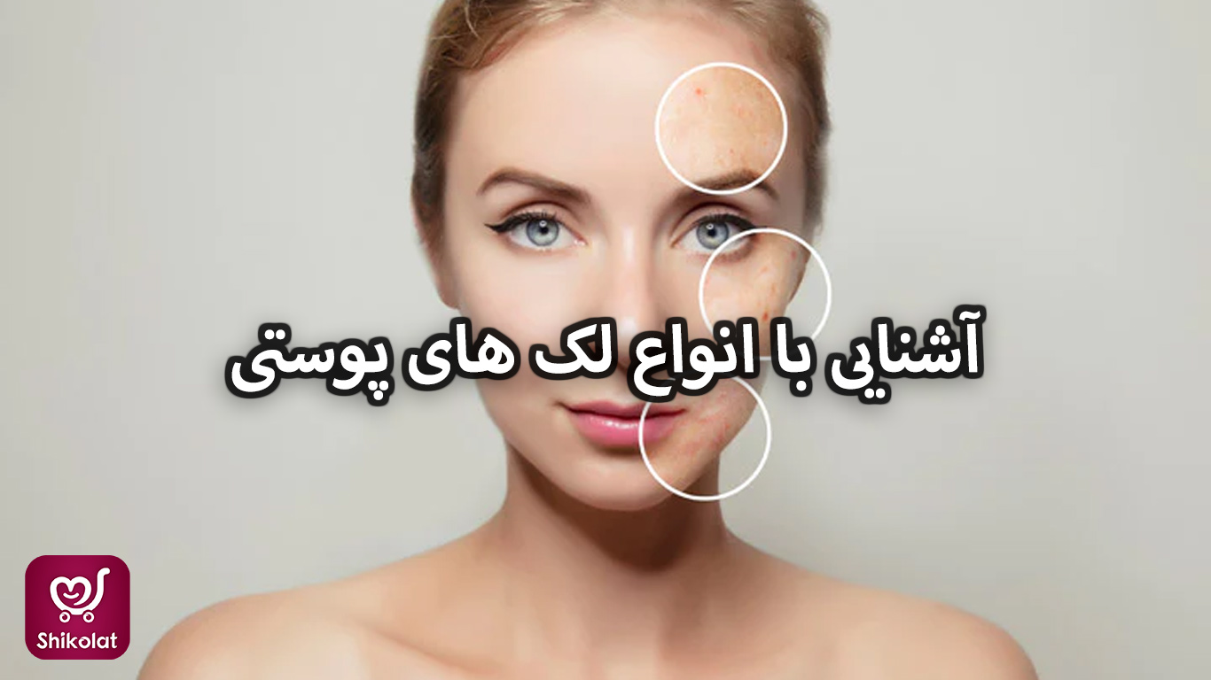 آشنایی با انواع لک های پوستی